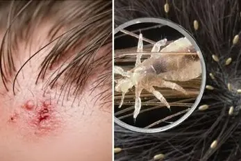تشخیص رشک و شپش سر؛ از بین بردن شپش مو در خانه، نحوه مکیدن خون سر و سوالات رایج