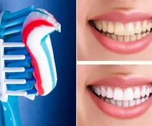 سفید کردن فوری دندان در خانه/ برا وقتی که واسه یه قرار مهم عجله داری مثه مروارید میشن