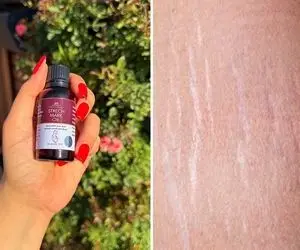 از بین بردن ترک های پوستی خانگی / عالی برا رفع ترک های زایمان و ناشی از چاقی و لاغری