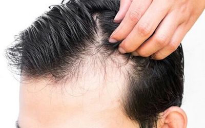 آیا ریزش مو درمان قطعی دارد؟