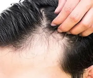 آیا ریزش مو درمان قطعی دارد؟