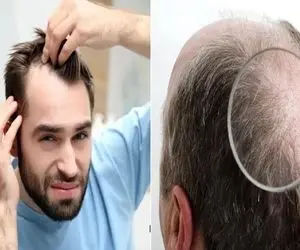 معرفی دکتران متخصص در درمان ریزش موی ارثی در کرج/ زیباییتو سر چیزی که دستت نبوده نباز