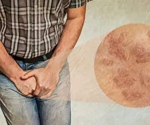 چگونه به بیماری پوستی تناسلی دچار نشویم؟