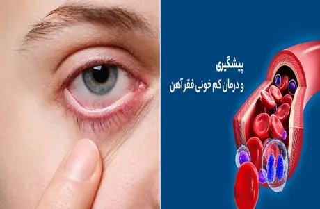 اگر این 5 نشانه رو دارید به احتمال قوی فقر آهن دارید| علامت خطری که اکثر ایرانیا دارن