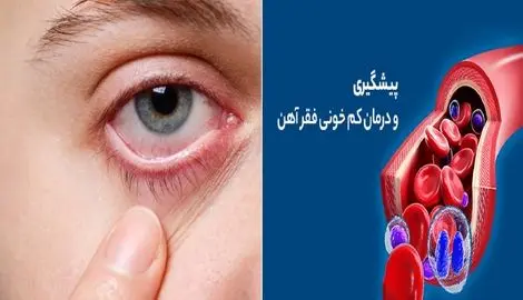 اگر این 5 نشانه رو دارید به احتمال قوی فقر آهن دارید| علامت خطری که اکثر ایرانیا دارن