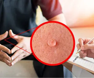 علت به وجود آمدن زگیل تناسلی شد؟ علائم + درمان