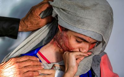 (تصاویر +16) زن یمنی قربانی اسیدپاشی همسرش