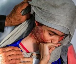 (تصاویر +16) زن یمنی قربانی اسیدپاشی همسرش