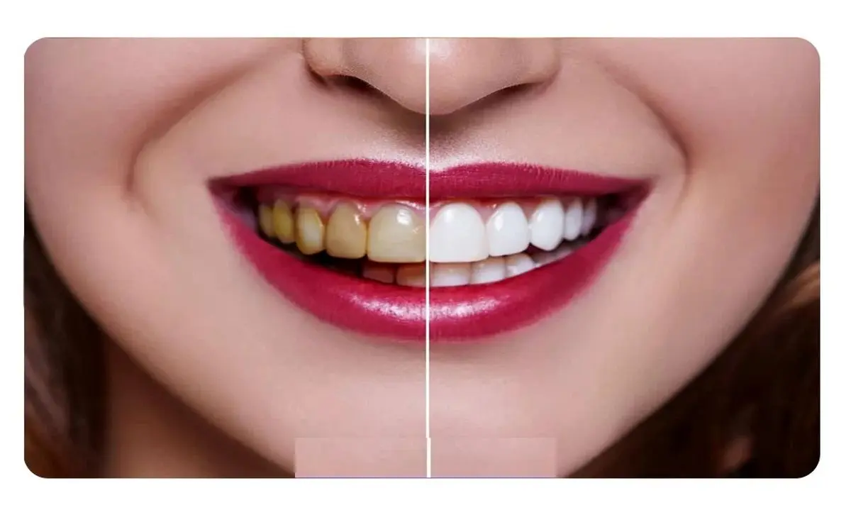 سفید کردن دندون ها با مواد طبیعی