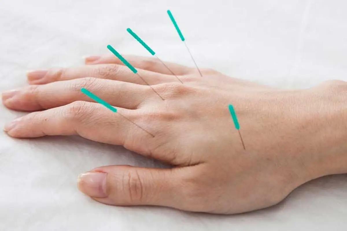 accupuncture