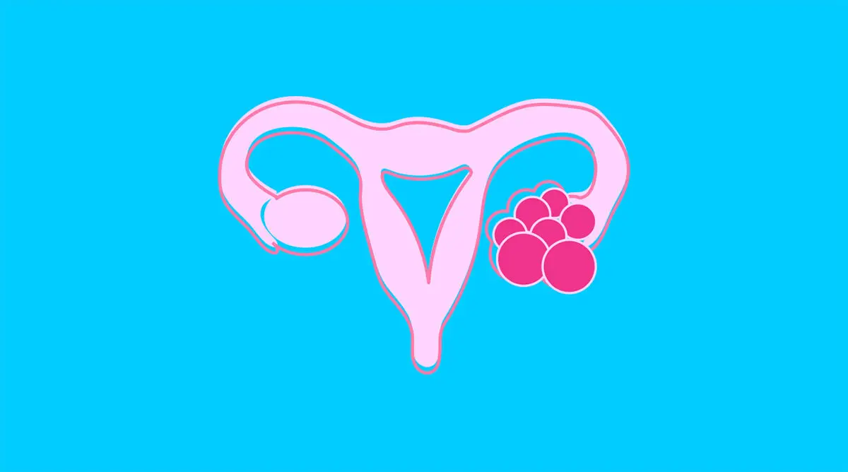 ovarian-cyst_l_a