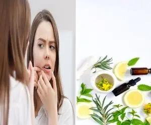 گیاهانی که برای از بین بردن جای جوش خوب هستن / چاره ی کار تو دله طبیعته بیخیال لیزر