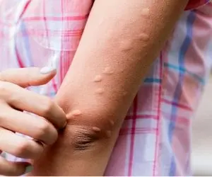 علت کهیر زدن؛ چرا بدنمان کهیر می‌زند؟