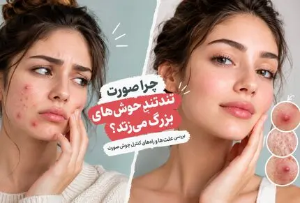 دلیل زدن جوش های بزرگ و سرسیاه؛ راه حل های شگفتانه برای رهایی همیشگی و صورتی صاف