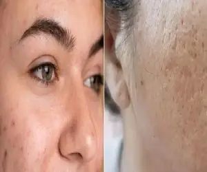 بهترین کرم برا از بین بردن جای جوش و لک های تیره و قهوه ای صورت/ پوستی شفاف و آینه ای