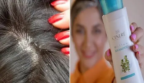 بهترین شامپوهای ضد خارش و شوره سر؛ از بین برنده قارچ سر و قطع کننده ریزش مو