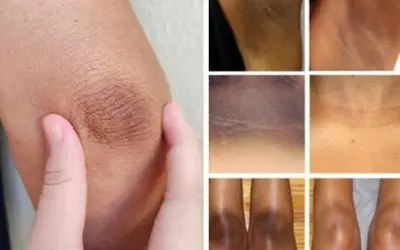 رفع تیرگی آرنج، زانو و کشاله ران؛ فقط ظرف دو هفته ذغال ترین هم باشی الماس ترین میشی