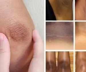 رفع تیرگی آرنج، زانو و کشاله ران؛ فقط ظرف دو هفته ذغال ترین هم باشی الماس ترین میشی