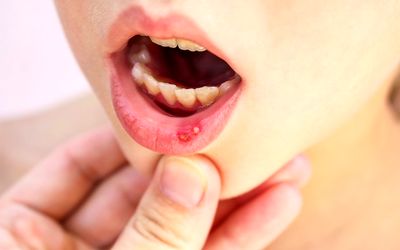 موثرترین و سریع ترین راه های درمان آفت دهان چیست؟