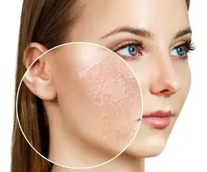 پوست خشک با دهیدراته زمین تا آسمون فرق داره ها؛ صفر تا صدش رو گفتم از علت تااا درمان