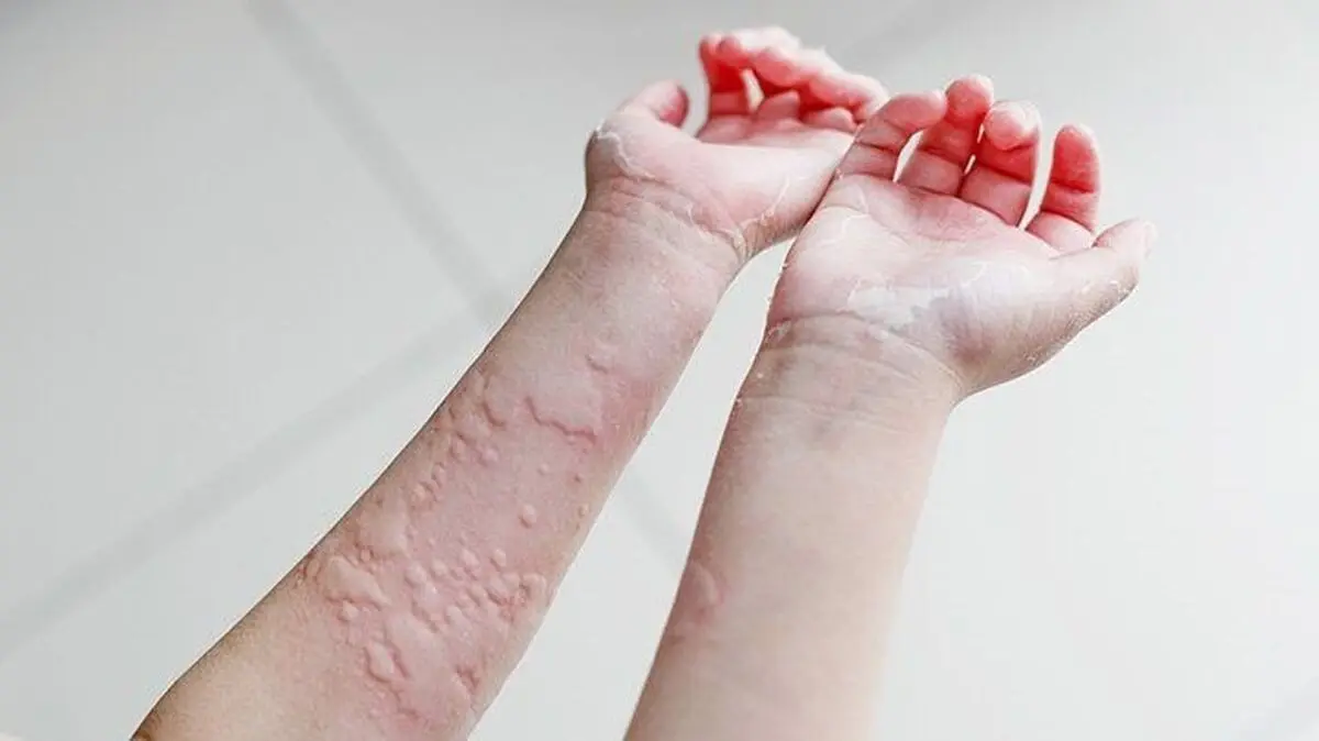 hives-defined-pezeshkbook