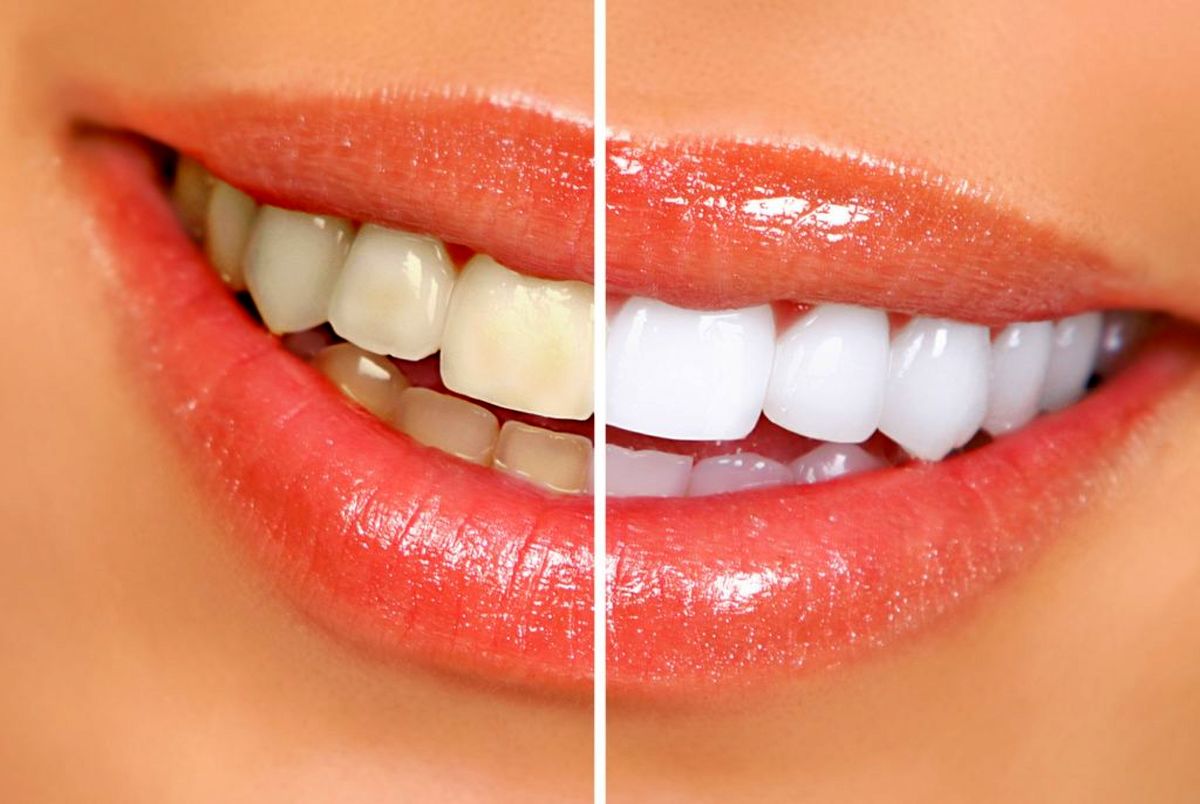Secrets to Whiter Teeth