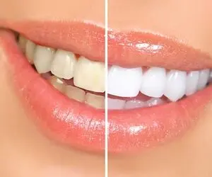با این ترفند های کم خرج دندوناتو مثل برف سفید کن؛ دیگه از لبخند زدن خجالت نکش