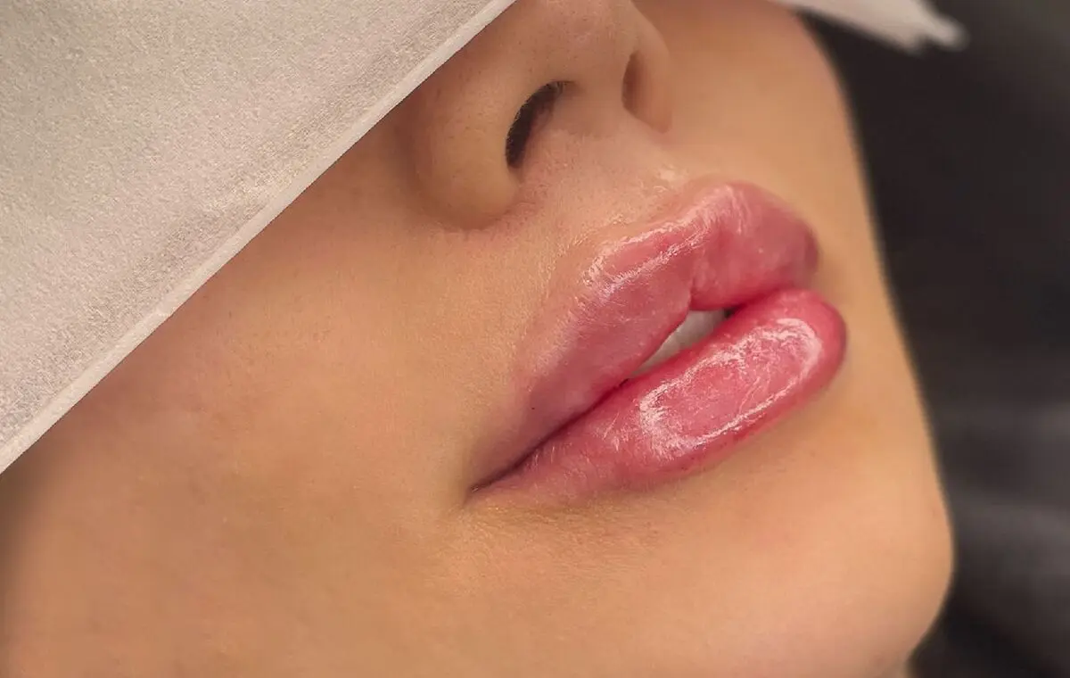 تفاوت ژل لب با فیلر