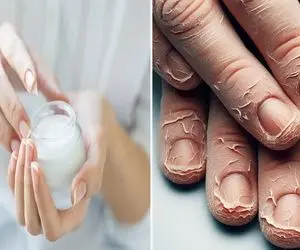 درمان پوست دادن اطراف ناخن / سن خانوما رو دستاشون لو میده پس برا جوون شدنشون تلاش کن