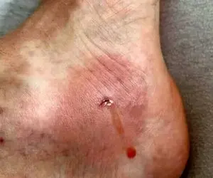 مرد مسنی که دچار گازگرفتگی شدید یک سفره ماهی شد!