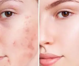 درمان جوش صورت با روش های موثر خانگی / اینجوری پوستت رو صاف و شفاف کن