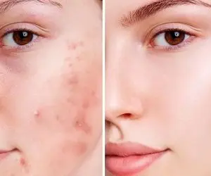 درمان جوش صورت با روش های موثر خانگی / اینجوری پوستت رو صاف و شفاف کن