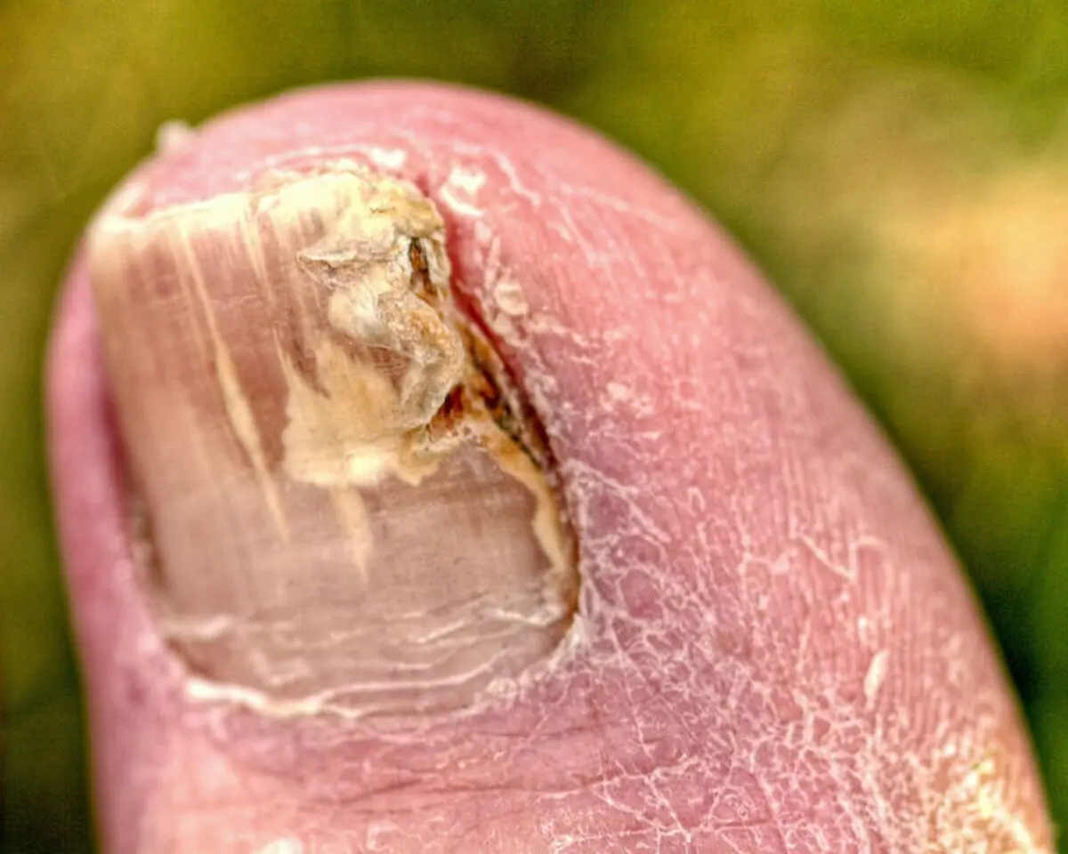 nail_fungus-696x557