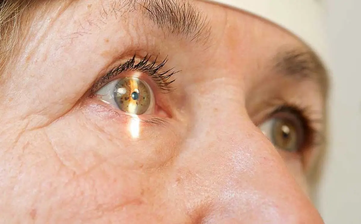 Cataract-2