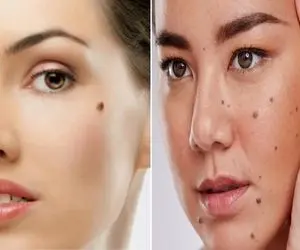 از بین بردن خال های صورت و بدن تنها در یک هفته؛ لیزر نکن پولتم هدر نده فقط با پیاز