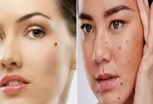 از بین بردن خال های صورت و بدن تنها در یک هفته؛ لیزر نکن پولتم هدر نده فقط با پیاز