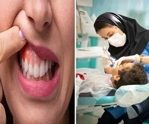برای ورم لثه دکتر نرو؛ با این ترفندا بزن تو پَر هر چی عفونت که جا خوش کرده تو لثه هات!