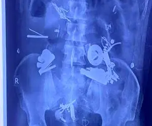 کشف 150 شیء فلزی و غیر فلزی از شکم یک بیمار!!