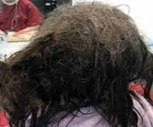 (عکس) باران شپش از موهای این دختر 