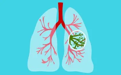 هر آنچه لازم است درباره سیستیک فیبروزیس بدانید!