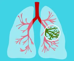 هر آنچه لازم است درباره سیستیک فیبروزیس بدانید!