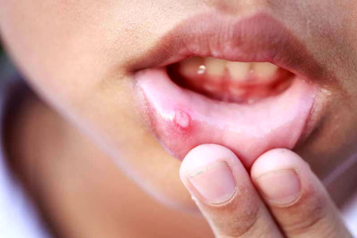 get-rid-of-canker-sores