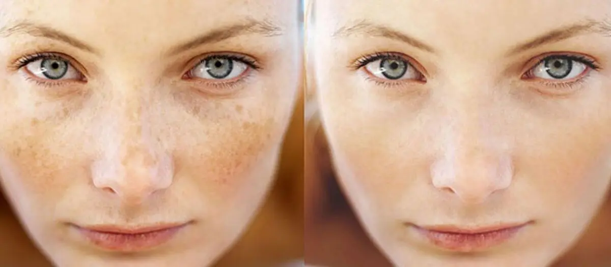 microneedling-1024x448