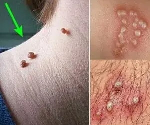 زگیل تناسلی چه شکلیه؟ گوشت اضافه چه شکلی؟ (درمان)