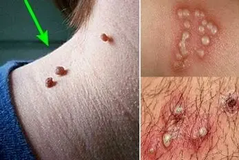زگیل تناسلی چه شکلیه؟ گوشت اضافه چه شکلی؟ (درمان)