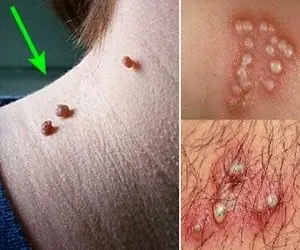 زگیل تناسلی چه شکلیه؟ گوشت اضافه چه شکلی؟ (درمان)