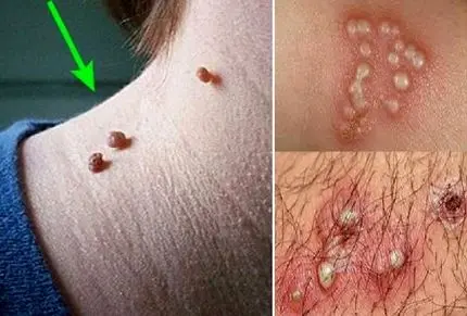 زگیل تناسلی چه شکلیه؟ گوشت اضافه چه شکلی؟ (درمان)