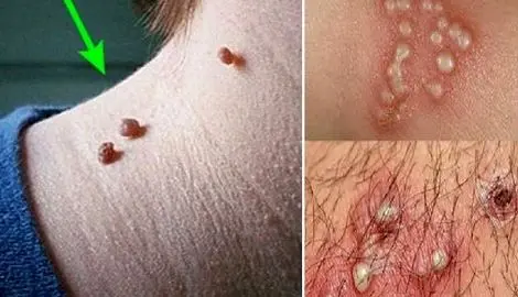 زگیل تناسلی چه شکلیه؟ گوشت اضافه چه شکلی؟ (درمان)