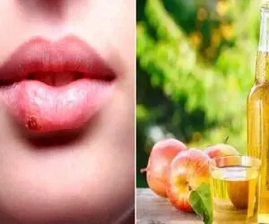 نابود کردن تبخال در همان روز اول؛ با این ژل تو نطفه خفه اش میکنی جاشم میره