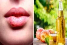 نابود کردن تبخال در همان روز اول؛ با این ژل تو نطفه خفه اش میکنی جاشم میره